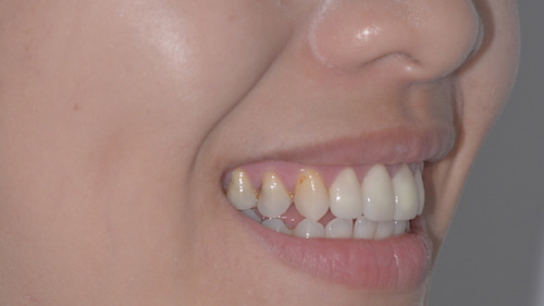 前牙美學精選案例-案例A
