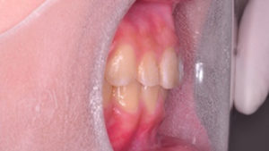 齒顎矯正案例A-small