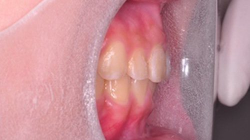 齒顎矯正精選案例-案例A