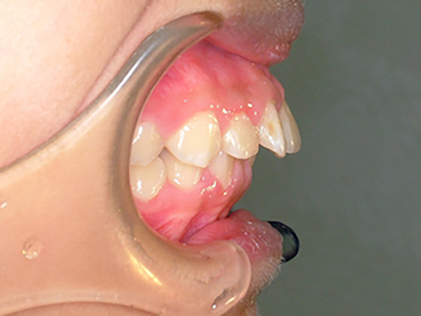 齒顎矯正案例A1