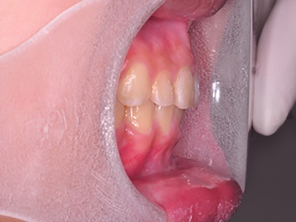 齒顎矯正案例A2