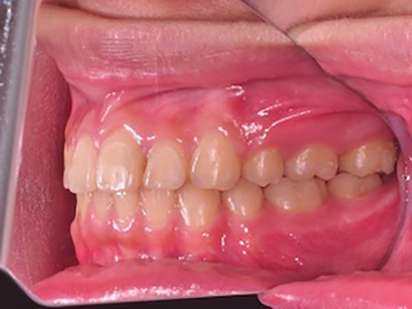 齒顎矯正案例A4