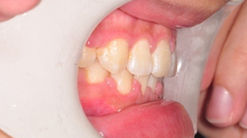 齒顎矯正精選案例-案例B