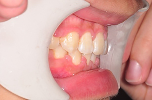 齒顎矯正案例B2
