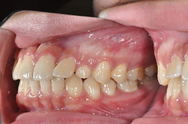 齒顎矯正案例B3