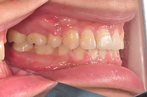 齒顎矯正案例B4