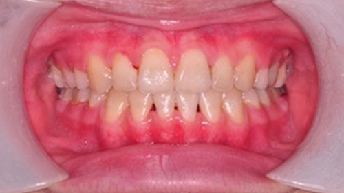 齒顎矯正精選案例-案例C