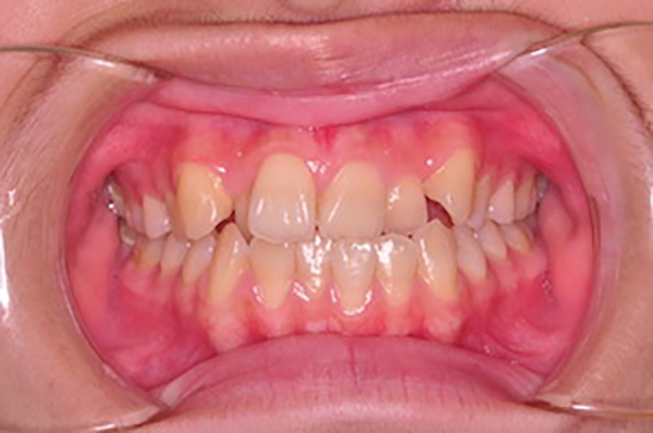 齒顎矯正案例C1