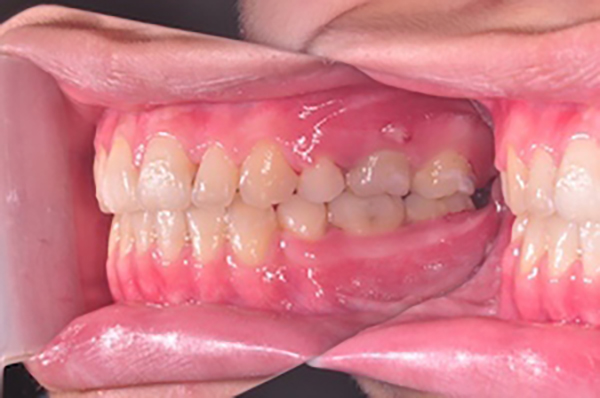 齒顎矯正案例C4