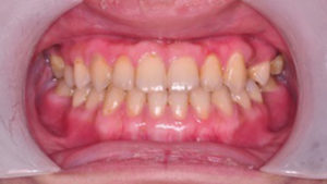 齒顎矯正案例D-small
