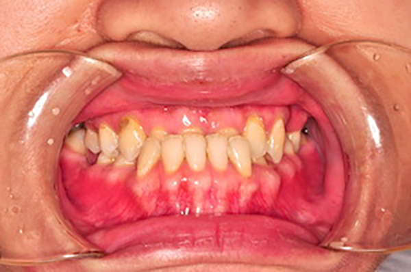 齒顎矯正案例D1