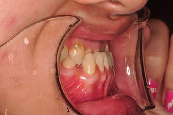 齒顎矯正案例D3