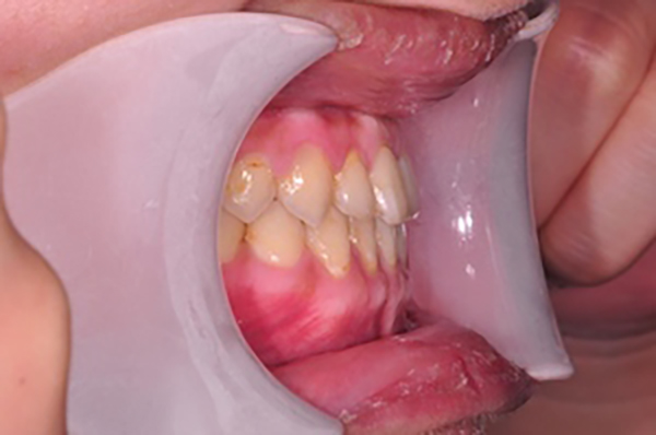 齒顎矯正案例D4