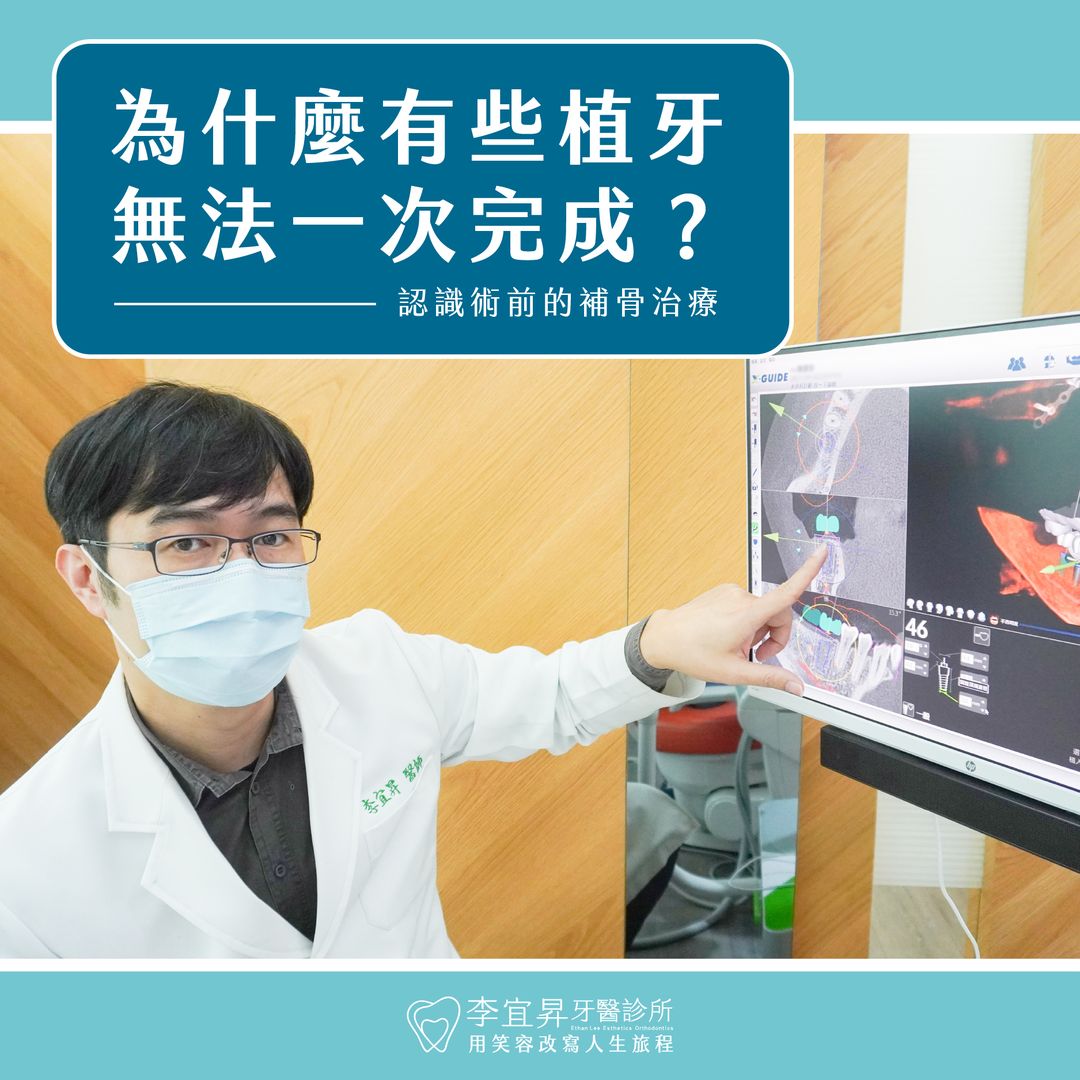 Read more about the article 為什麼有些植牙無法一次完成？認識術前的補骨治療