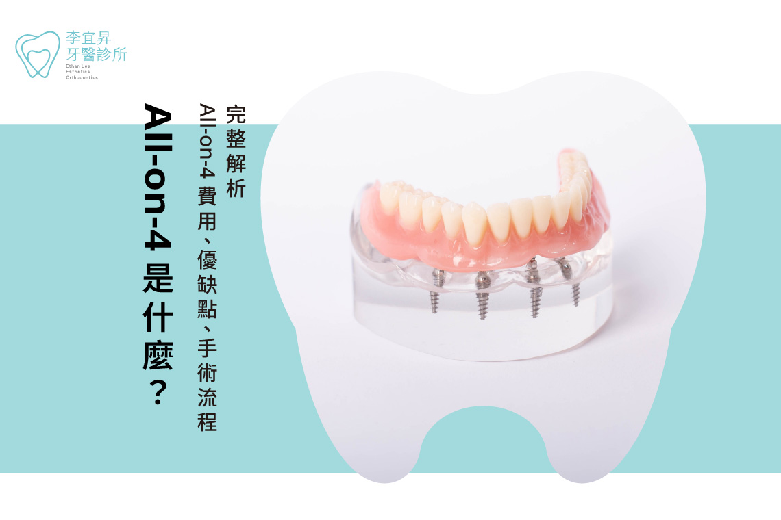 All on 4懶人包，All-on-4是什麼？全口重建流程、費用、原理一次看！