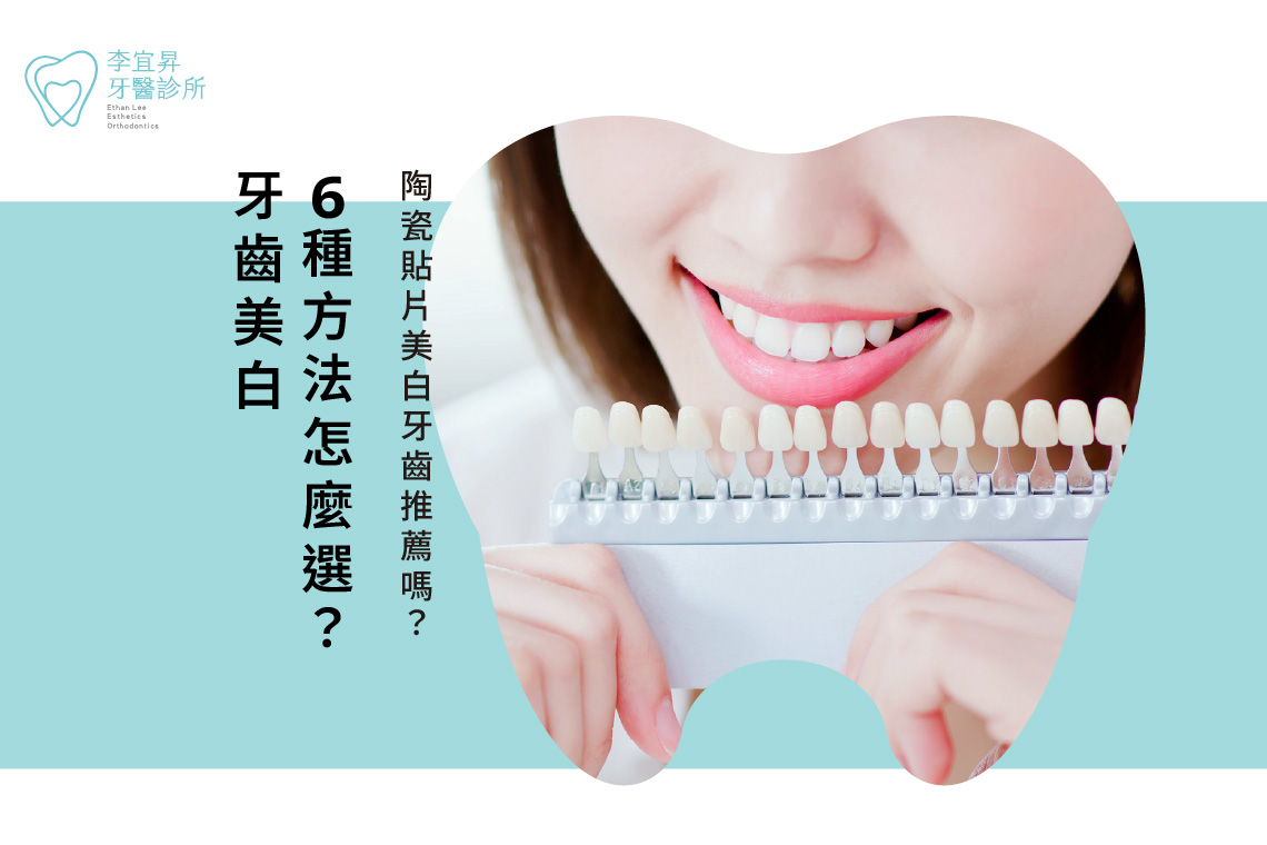 6種牙齒美白方法怎麼選？陶瓷貼片美白牙齒推薦嗎？
