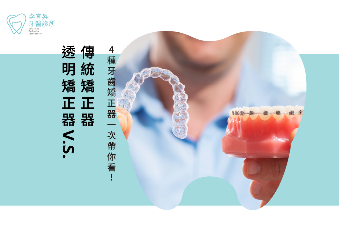Read more about the article 透明矯正器V.S.傳統矯正器哪個好？4種牙齒矯正器一次帶你看！