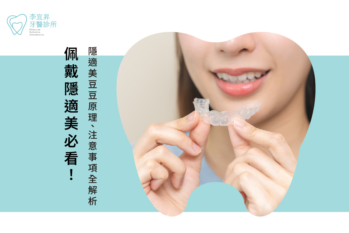 Read more about the article 配戴隱適美必看！隱適美豆豆原理、注意事項全解析