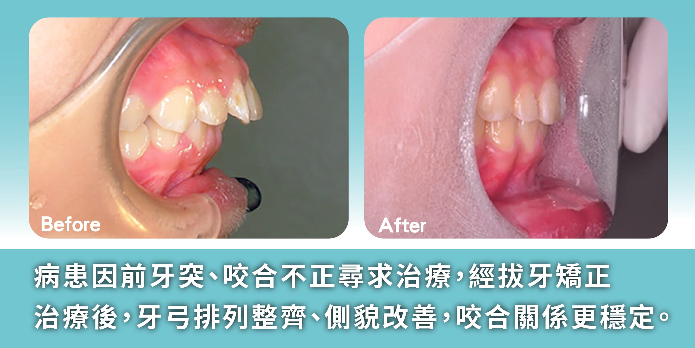 拔牙矯正案例