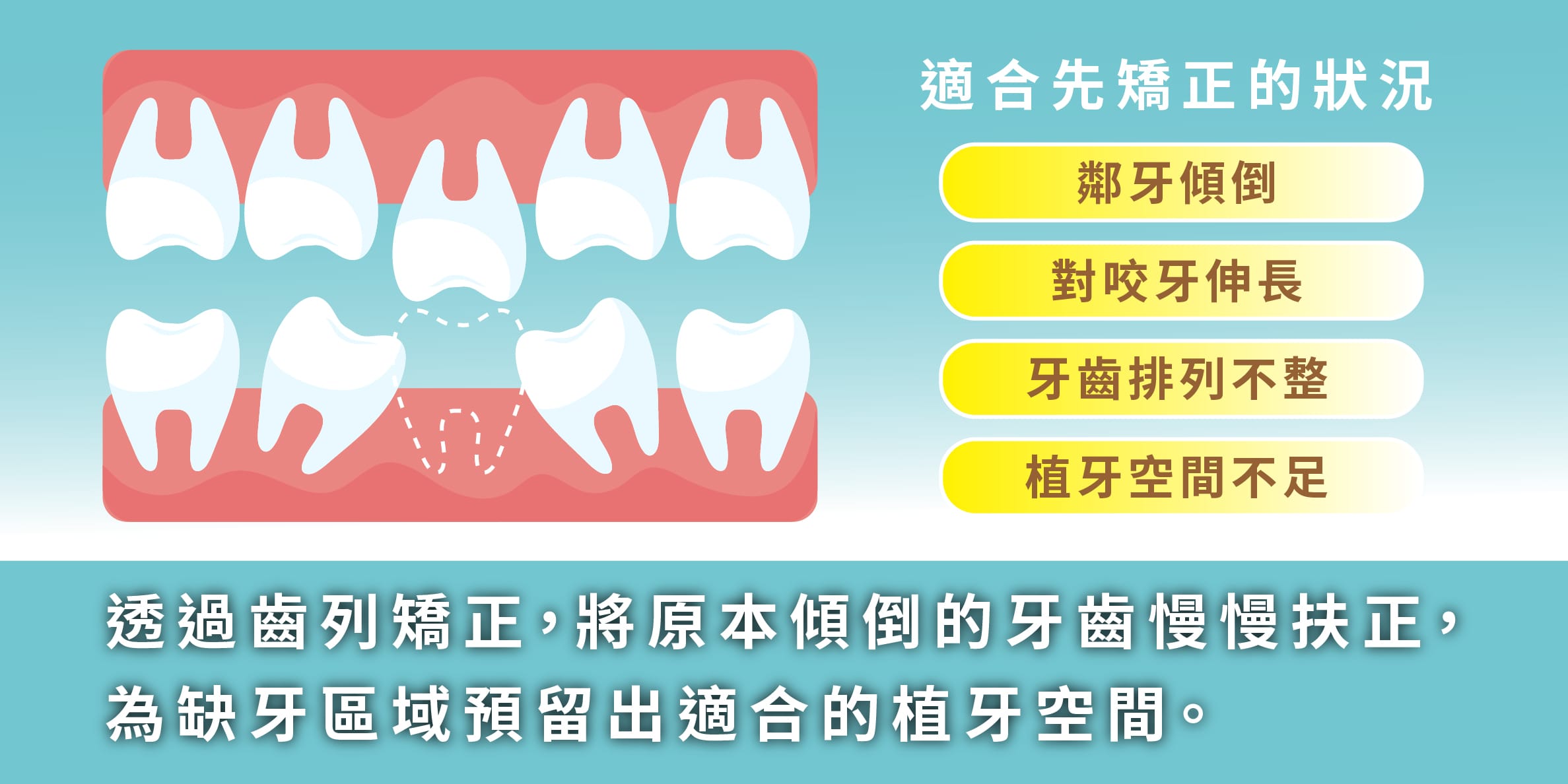 缺牙矯正說明圖