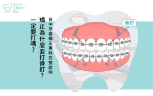 矯正為什麼要打骨釘