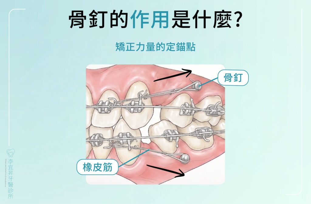 骨釘是矯正力量的定錨點