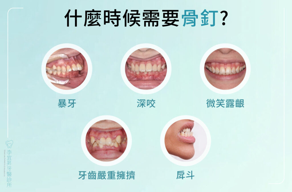 什麼時候需要骨釘?暴牙、深咬、戽斗、微笑露牙齦、牙齒嚴重擁擠