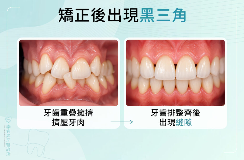 牙齒長期重疊擁擠,牙肉被擠壓在較低位置。牙齒排整齊後,牙齒之間出現縫隙。